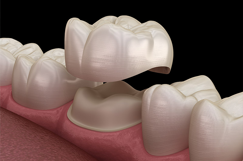 Dental Bridges in Laurel