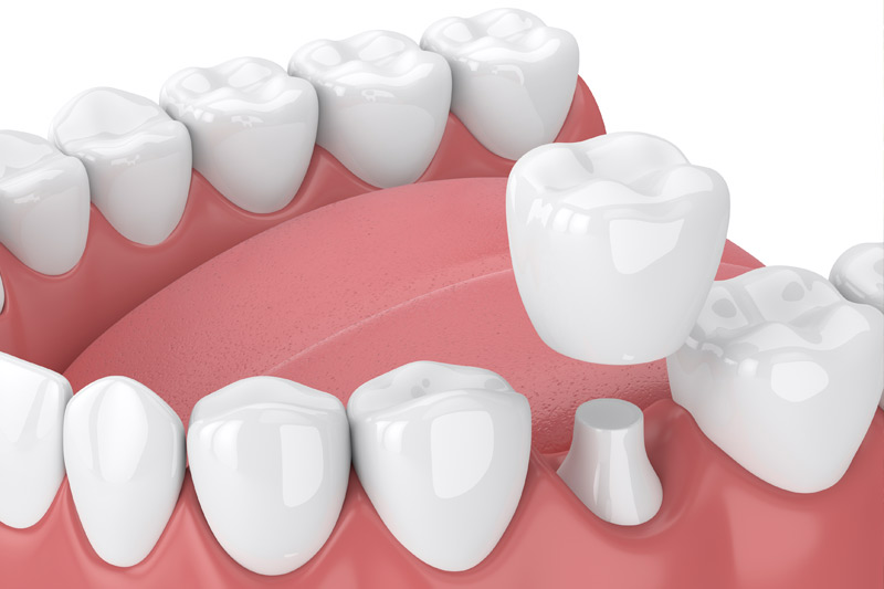 Dental Crowns in Laurel
