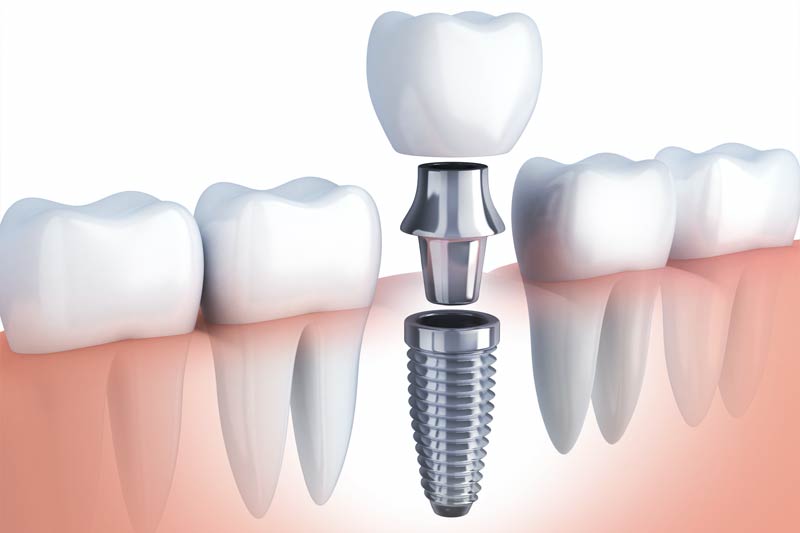 Dental Implants in Laurel