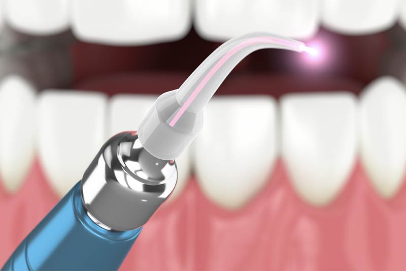 Laser Dentistry in Laurel