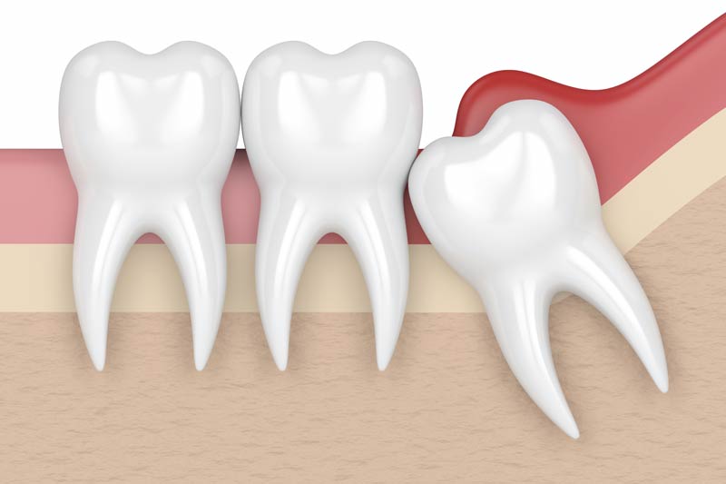 Wisdom Tooth Removal in Laurel